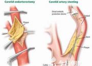 【今日朝阳网】朝阳市中心医院成功救治一位多发血管狭窄患者（郭海波）